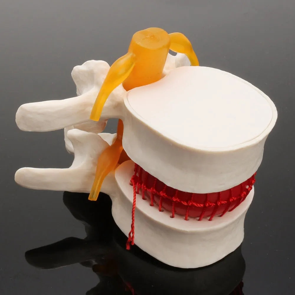 White PVC medical demonstration model of lumbar intervertebral disc herniation for anatomical education