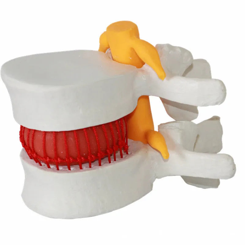 White PVC medical demonstration model of lumbar intervertebral disc herniation for anatomical education