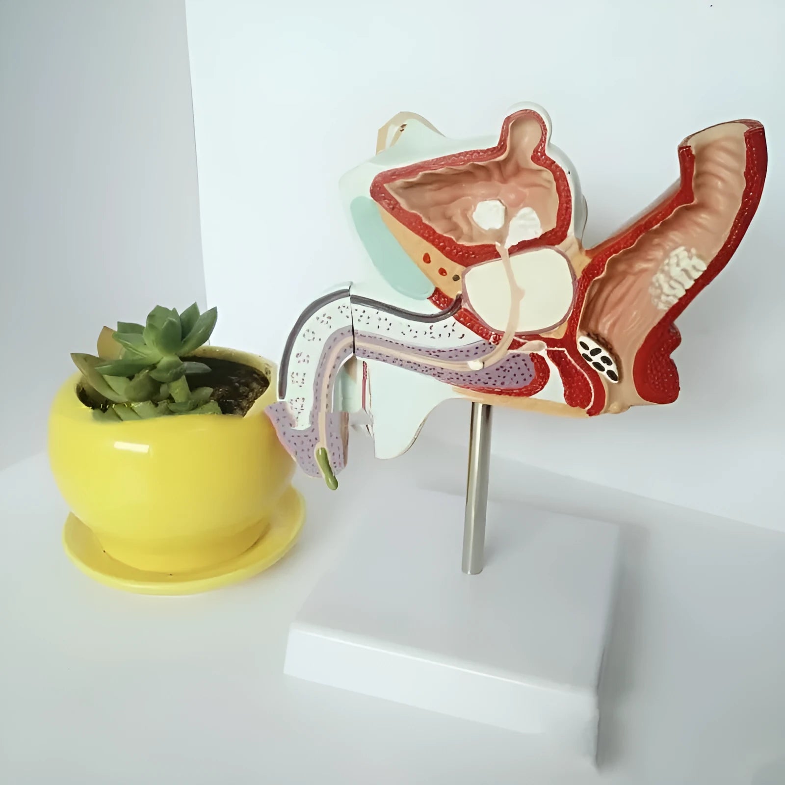 Anatomical model of male reproductive system showing pathologies like benign prostatic hyperplasia