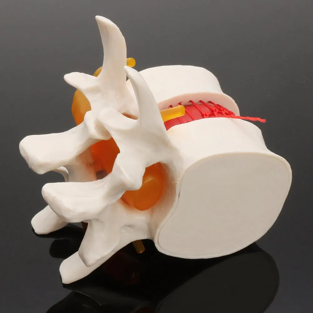White PVC medical demonstration model of lumbar intervertebral disc herniation for anatomical education