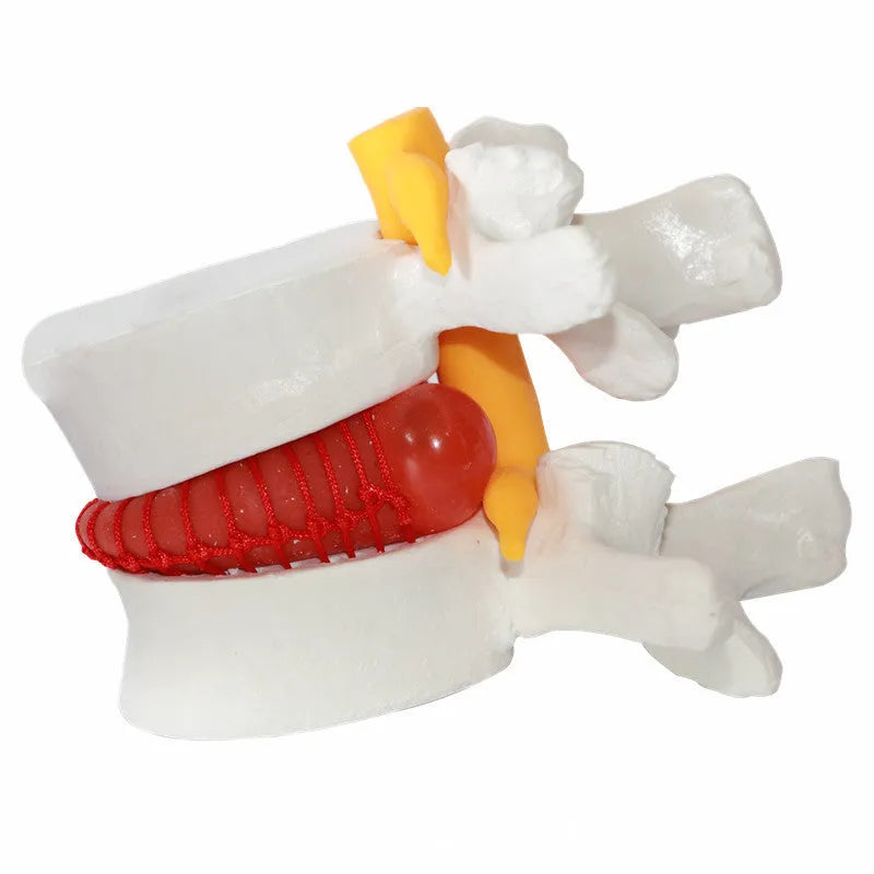 White PVC medical demonstration model of lumbar intervertebral disc herniation for anatomical education