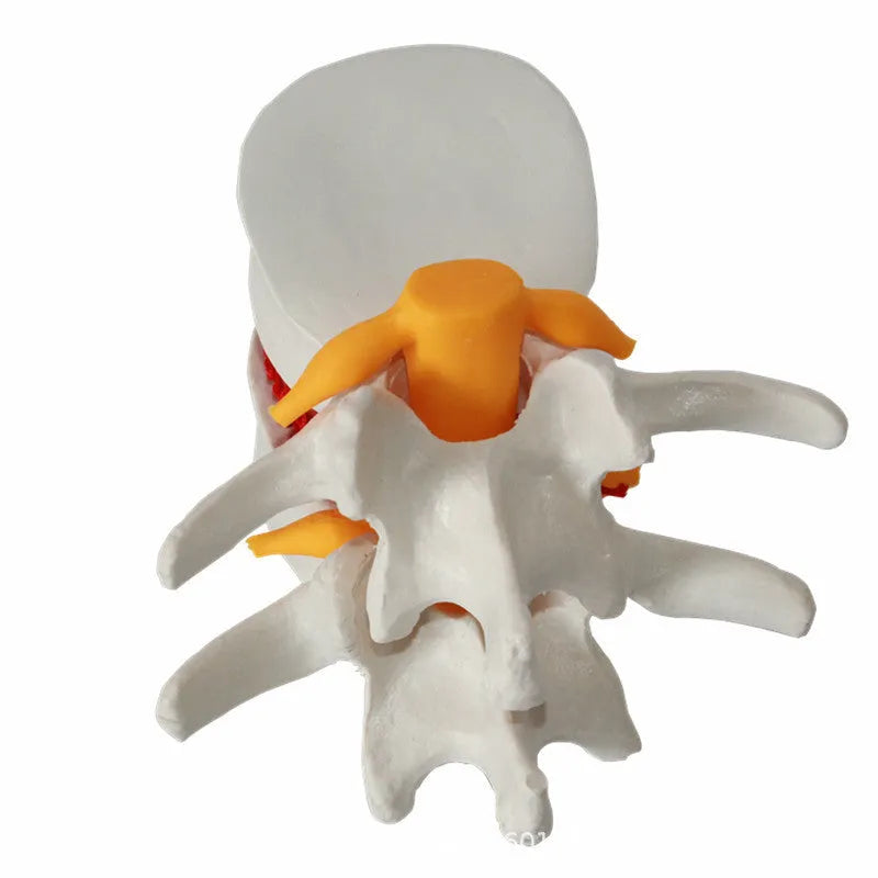 White PVC medical demonstration model of lumbar intervertebral disc herniation for anatomical education