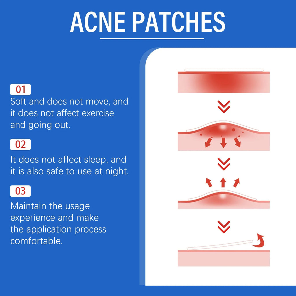 216 acne patches with tea tree oil and vitamin E formulation for facial blemish treatment