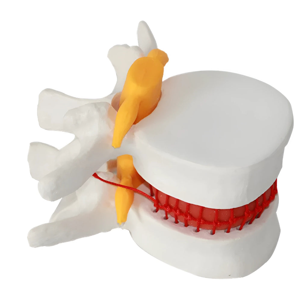 White PVC medical demonstration model of lumbar intervertebral disc herniation for anatomical education
