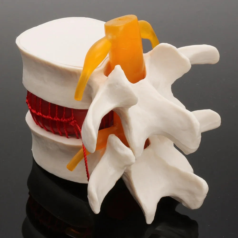 White PVC medical demonstration model of lumbar intervertebral disc herniation for anatomical education