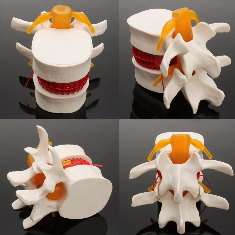 White PVC medical demonstration model of lumbar intervertebral disc herniation for anatomical education