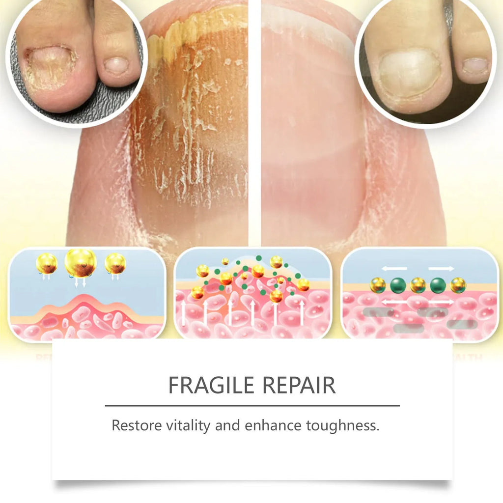 50ml bottle of nail fungus care solution with bee venom and peppermint oil
